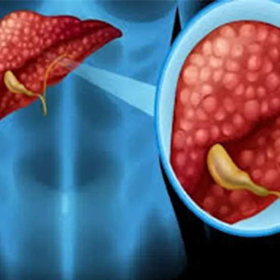 Liver Abscess: Types, Causes, Symptoms & Treatment